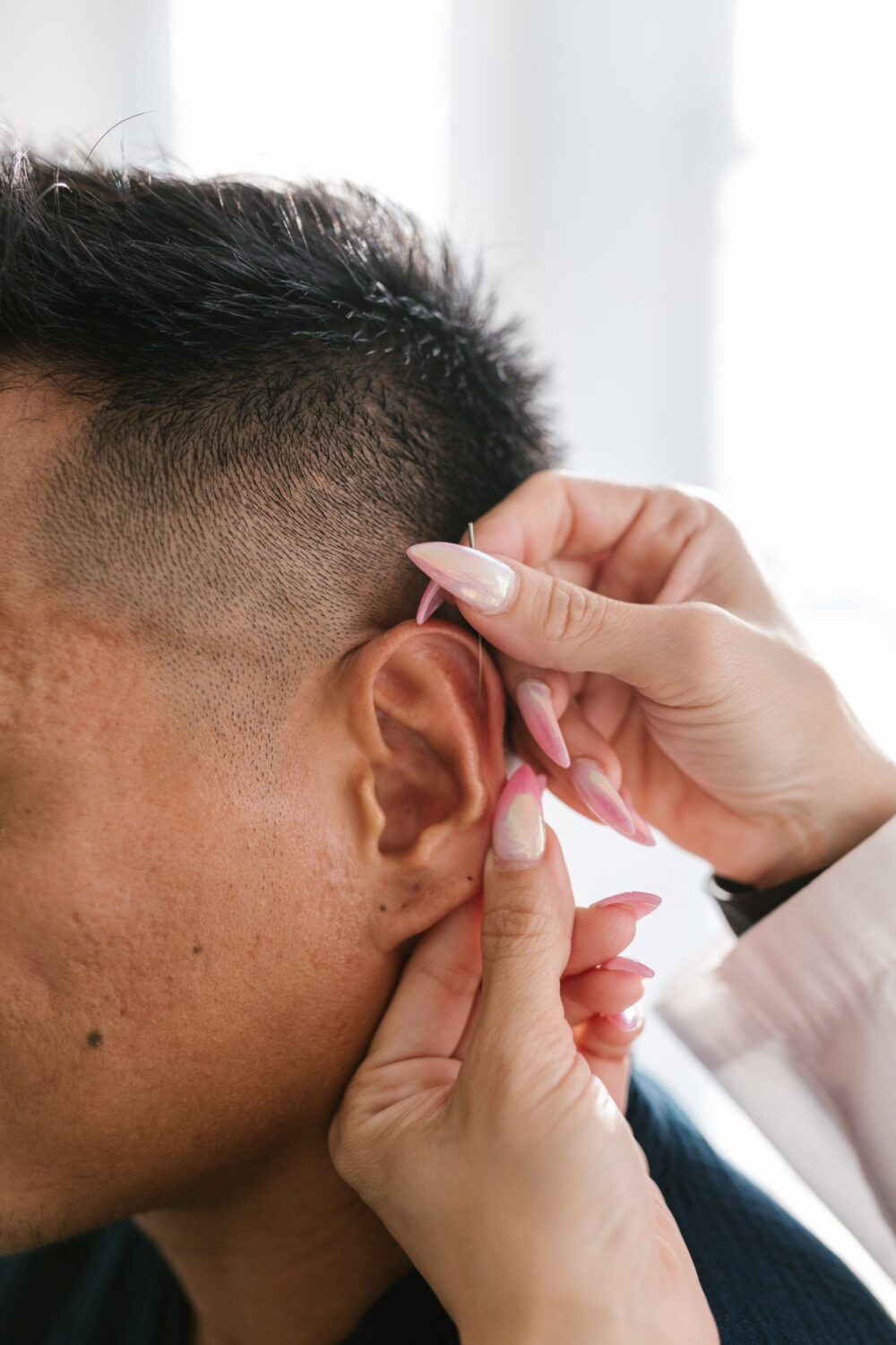 ear acupuncture